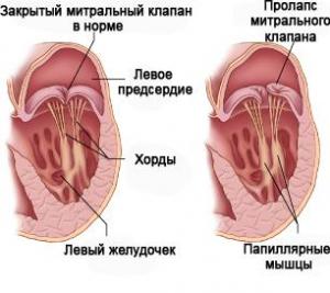 Пролапс митрального клапана