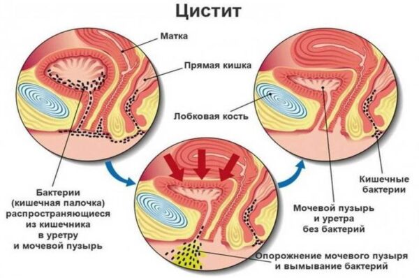 Циститы: Что необходимо знать каждой женщине Циститы: Что необходимо знать каждой женщине