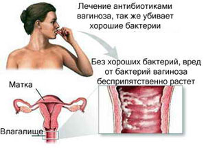 Нарушение микрофлоры влагалища